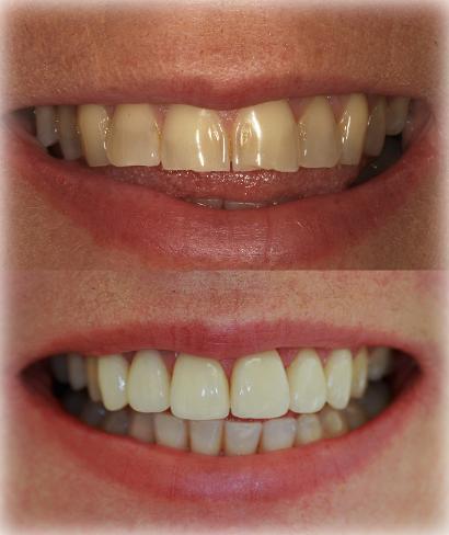 cosmetic dentistry west auckland, cosmetic dental treatment